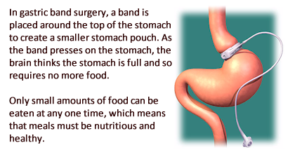About gastric band surgery